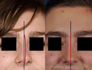crooked-nose-female-before-after