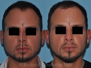 crooked-nose-male-before-after