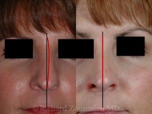 crooked-nose-rhinoplasty