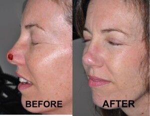 nasal-reconstruction-surgery-ex-2
