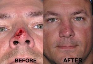 nasal-reconstruction-surgery-ex-3
