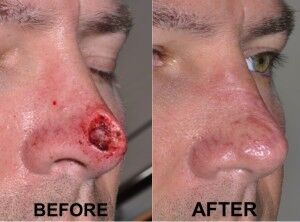 nasal-reconstruction-surgery-ex-4