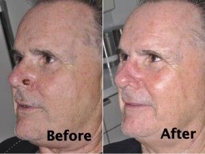 nasal-reconstruction-surgery-ex-5