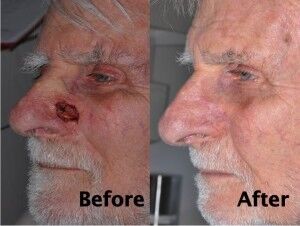 nasal-reconstruction-surgery-ex-6