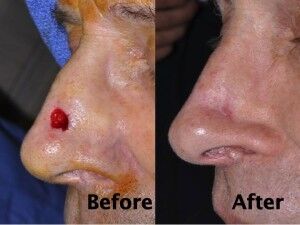 nasal-reconstruction-surgery-ex-7