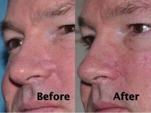 nasal-reconstruction-surgery-ex-8