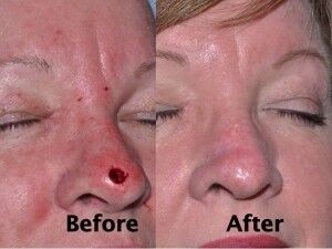 nasal-reconstruction-surgery-ex-9