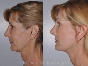 beverly-hills-mini-facelift-01