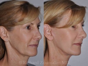 beverly-hills-mini-facelift-03
