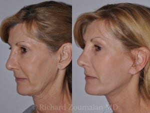 beverly-hills-mini-facelift-04