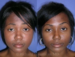 female-rhinoplasty-los-angeles-01