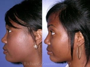African American Rhinoplasty