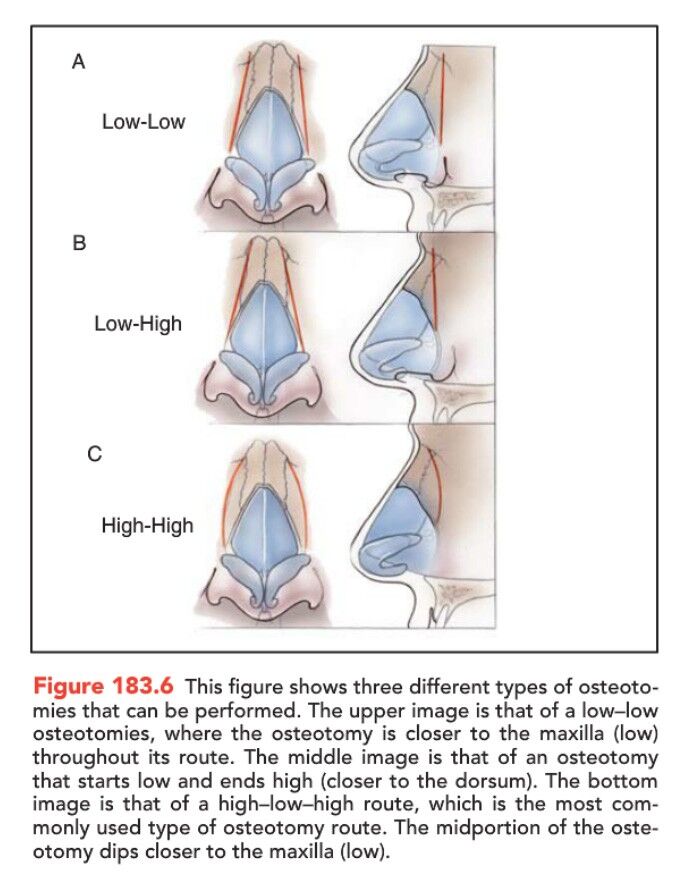 rhinoplasty-term-osteotomies