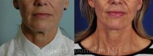 female-necklift-before-after-01