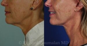 female-necklift-before-after-02