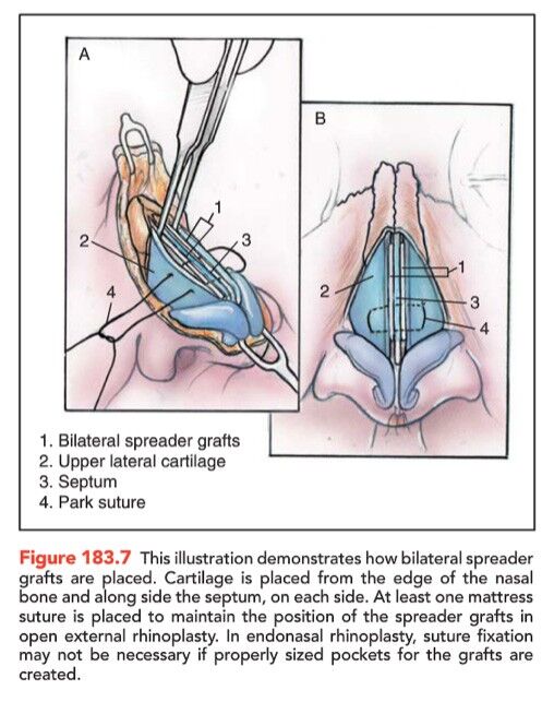 rhinoplasty-term-spreader-graft